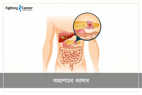অগ্ন্যাশয়ের ক্যান্সার